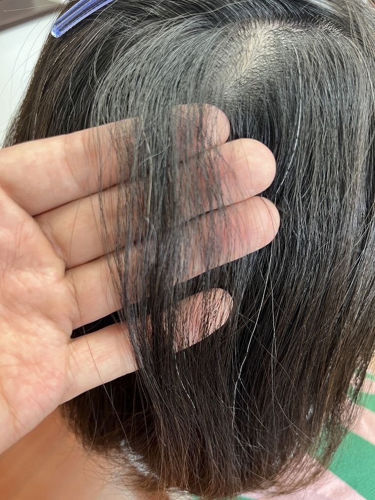 後頭部のチリつき部分