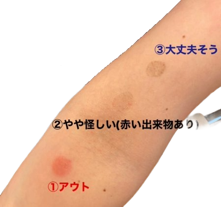 パッチテストの結果が出ている腕の写真