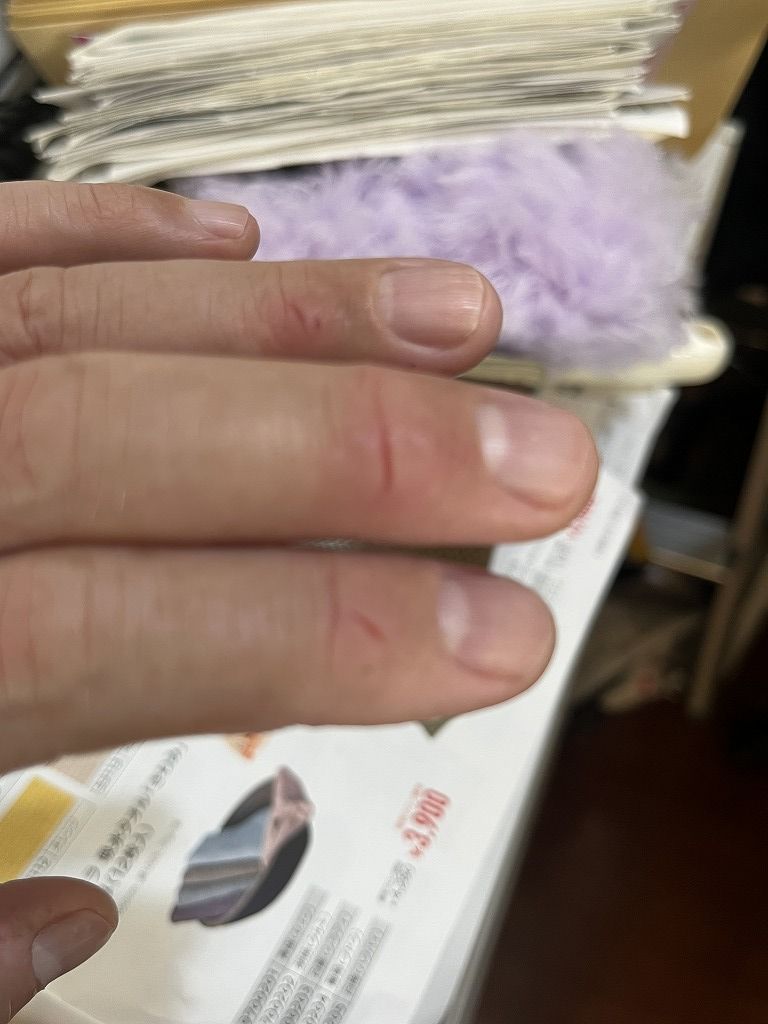 美容師の手荒れ:先週1週間働いた後の手の状態(指に赤み・乾燥・ヒビ)