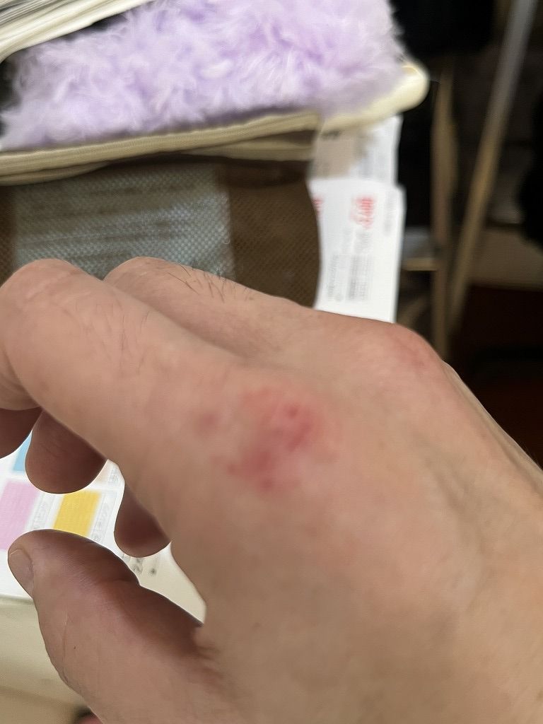 美容師の手荒れ:手の甲の赤み・炎症が出ている状態