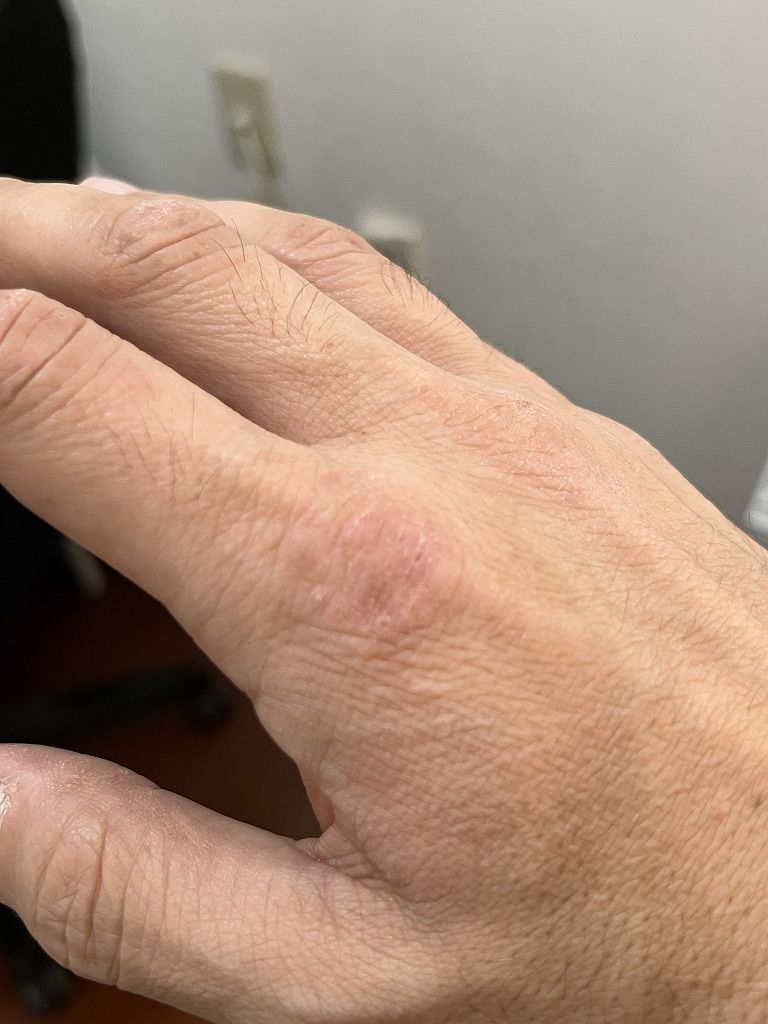 手荒れの経過:連休1日目の手の状態(保護後)