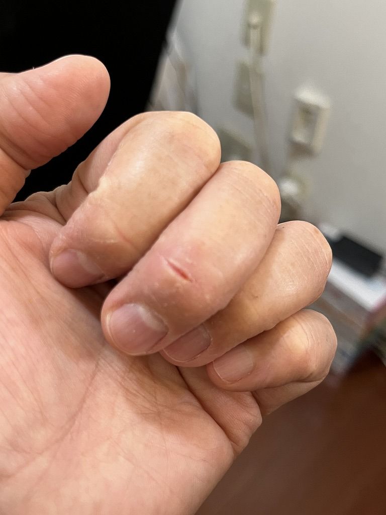 手荒れの経過:連休1日目の手の状態(乾燥・赤みが残る)