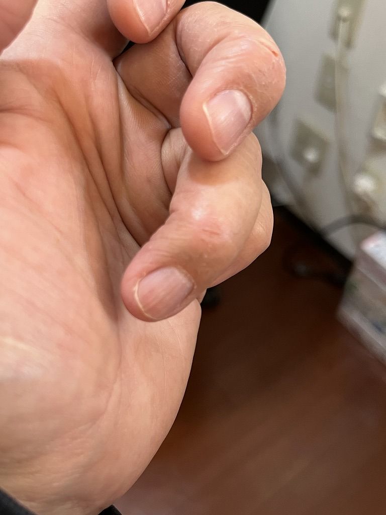 手荒れの経過:連休1日目の手の状態(指の乾燥とヒビ)