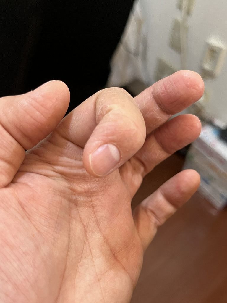 連休1日目:中指だけ割れているが他は塞がり始めた手の状態