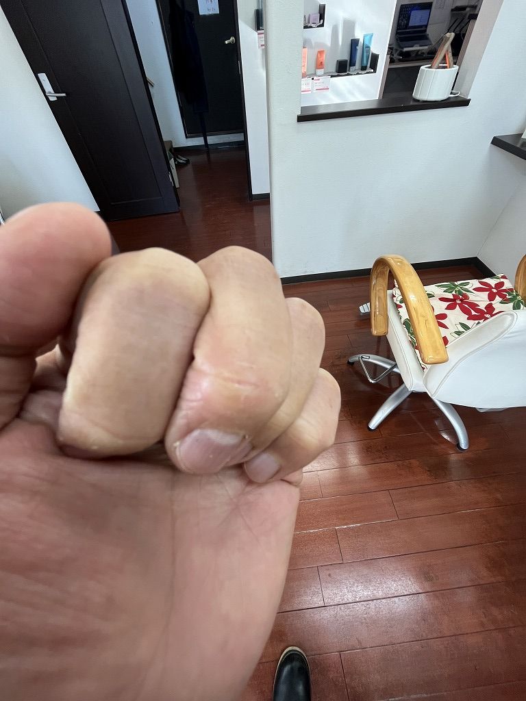 手荒れの経過:定休日2日目に中指の傷が塞がった状態