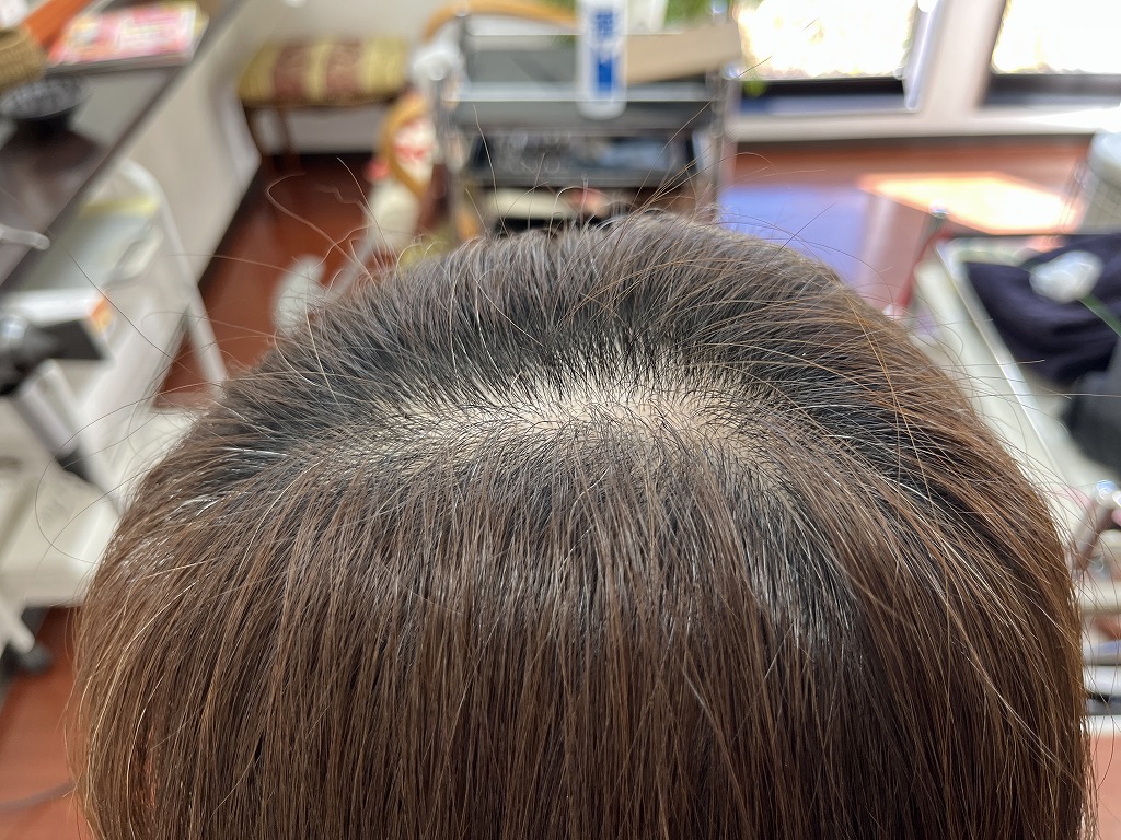 【ビフォー】リタッチカラー前の根元付近｜1か月分伸びた根元と白髪が少し気になる状態