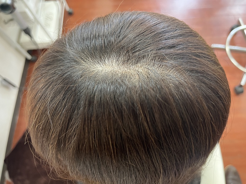 リタッチカラー施術後（根元）白髪が自然にカバーされた状態