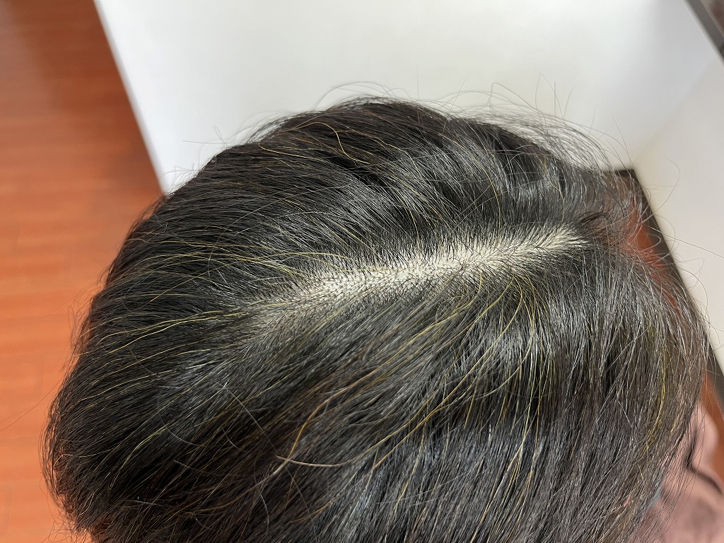 ハナヘナ2度染めのアフター根元写真。分け目の白髪が自然に馴染んだ状態。