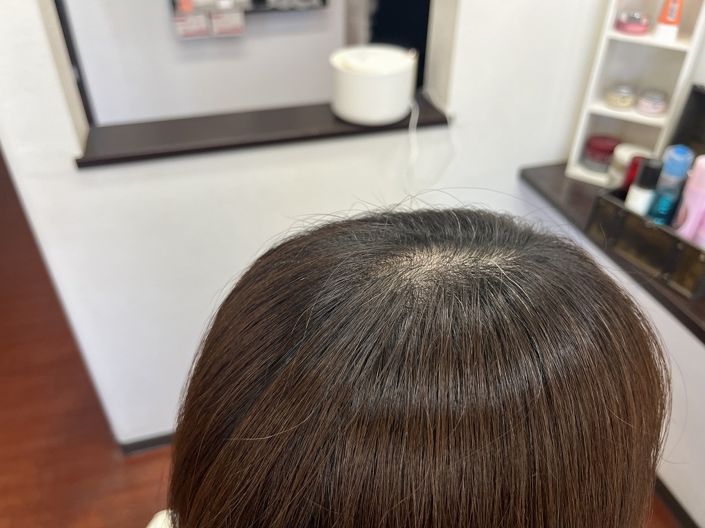 40代女性の施術前の頭頂部の白髪の状態