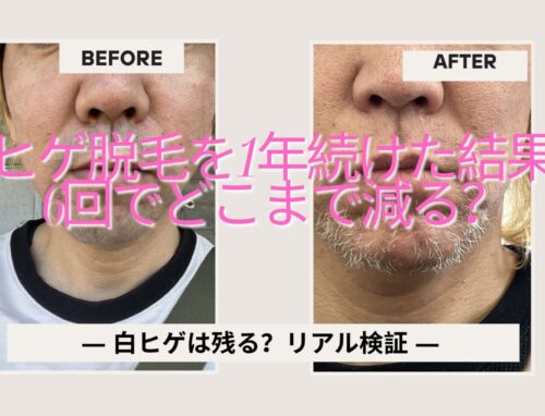ヒゲ脱毛を1年6回やってみた結果｜青ヒゲは消える？白ヒゲは残る？