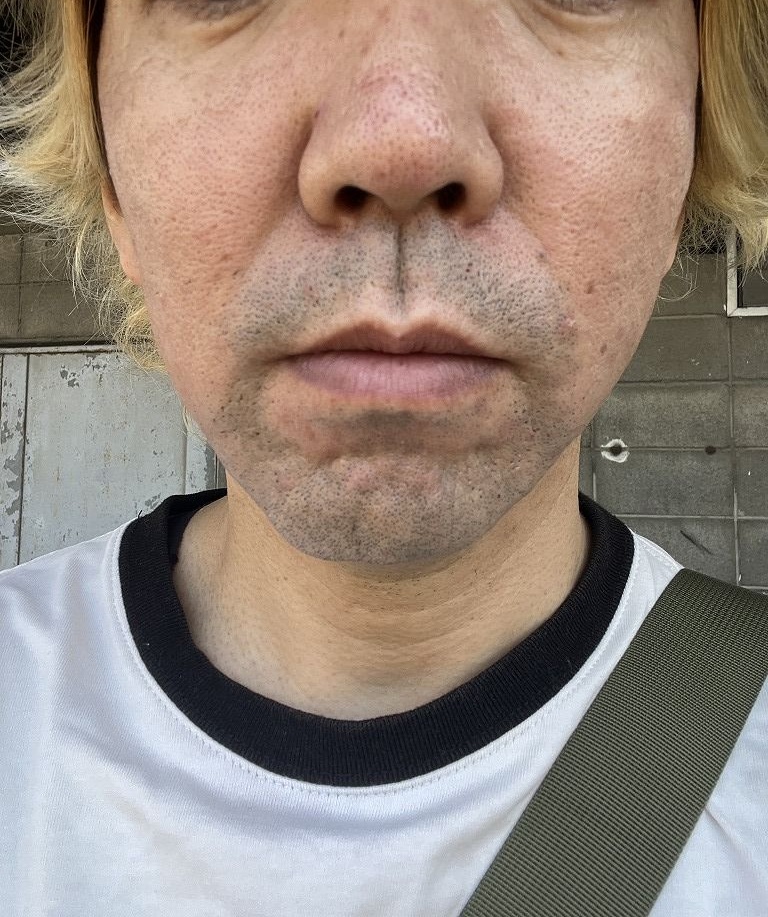 ヒゲ脱毛体験前のヒゲの状態