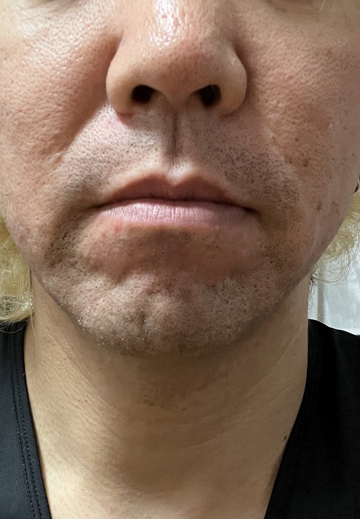 ヒゲ脱毛2回目前後の経過写真