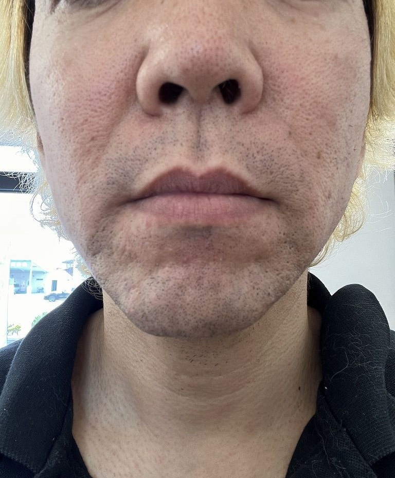 ヒゲ脱毛3回目から4回目あたりの経過写真
