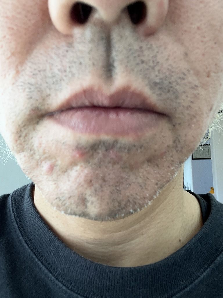 ヒゲ脱毛途中で肌荒れが出た時の写真