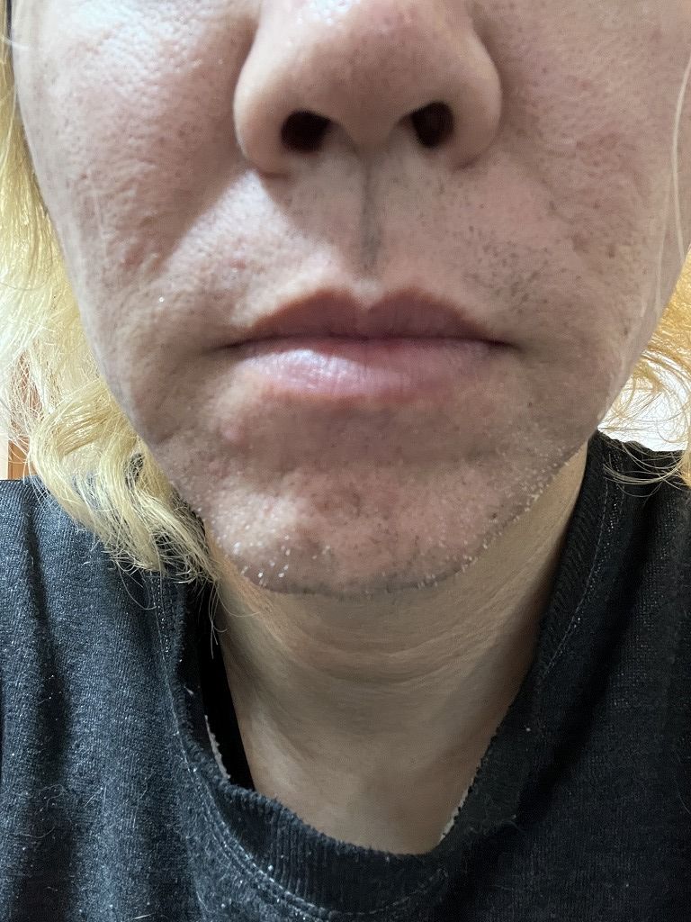 ヒゲ脱毛5回目前後の経過写真