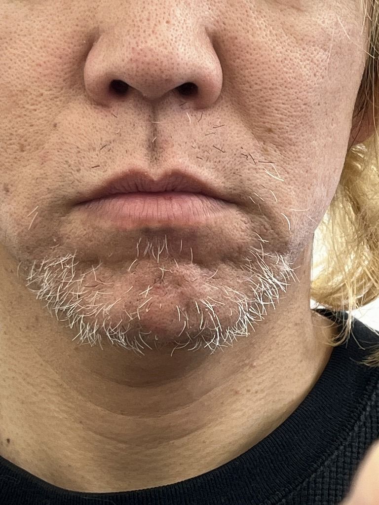 ヒゲ脱毛6回終了後の写真