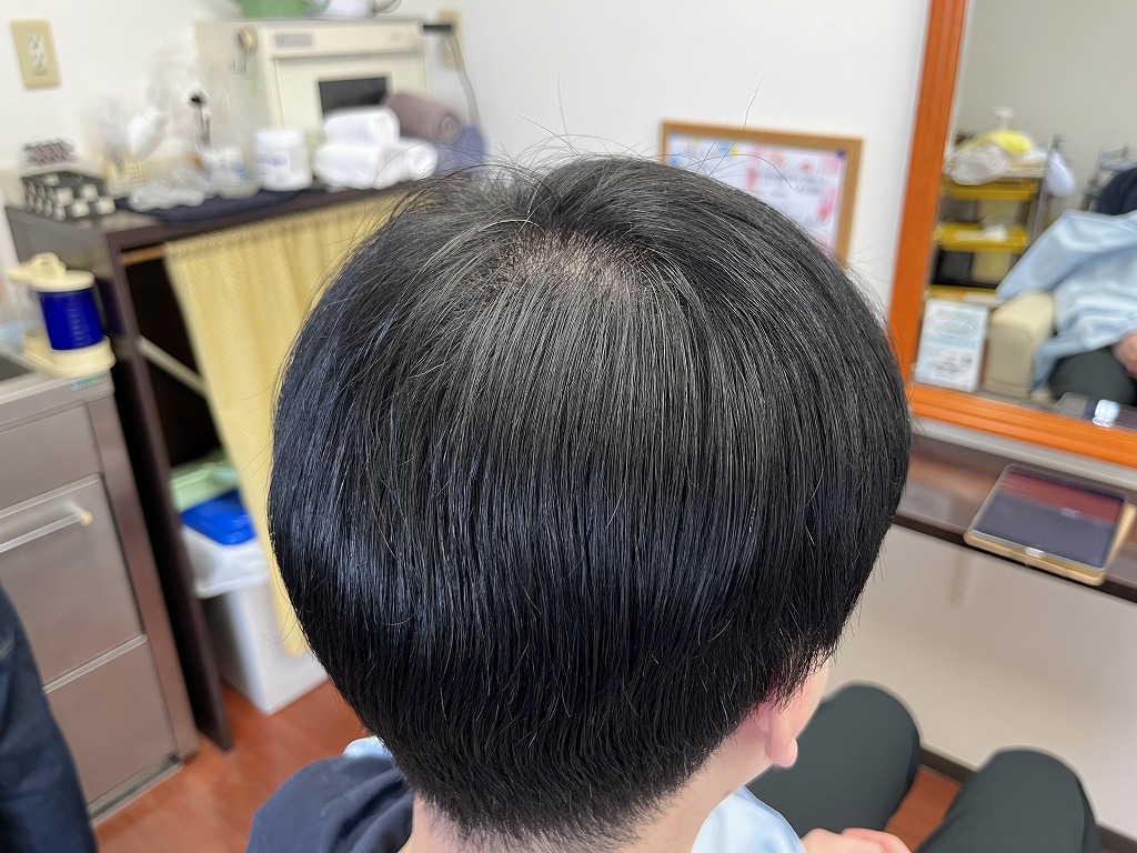 メンズ縮毛矯正のアフター後頭部。クセによる膨らみが収まり自然な丸みが出た状態
